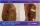 Abdominal And Flanks Liposution With Breast Fat Transfer - before (left) and after (right) result