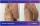 Abdominal Liposuction - before (left) and after (right) result