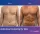 Abdominal Sculpting For Men - before (left) and after (right) result