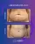 Abdominoplasty - before (top) and after (bottom) result