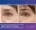 Blepharoplasty Upper Eyelids - before (left) and after (right) result