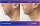 Chin Liposutction - before (left) and after (right) result