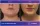 Face And Chin Liposuction - before (left) and after (right) result