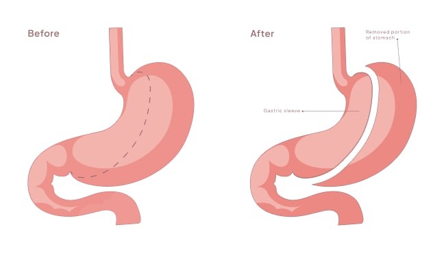 Vertical Sleeve Gastrectomy