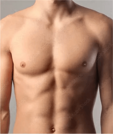 Gynecomastia