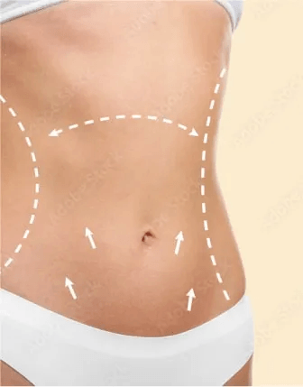 Tummy Tuck