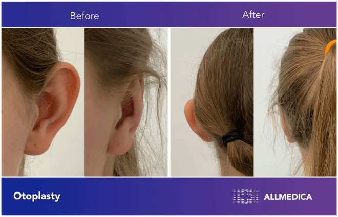 Otoplasty