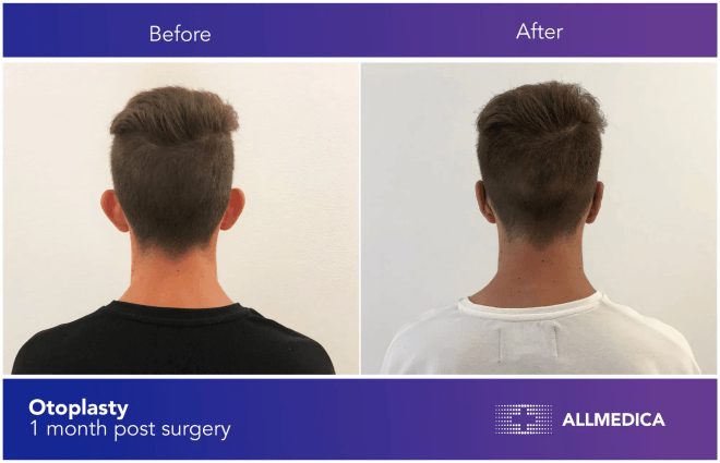 Otoplasty surgery