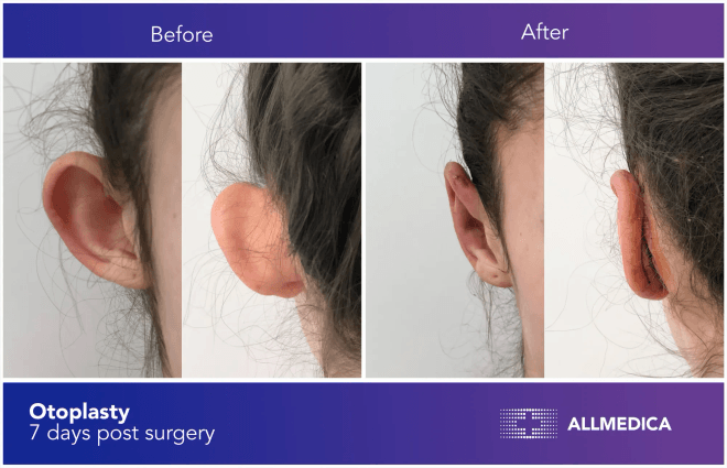Otoplasty surgery