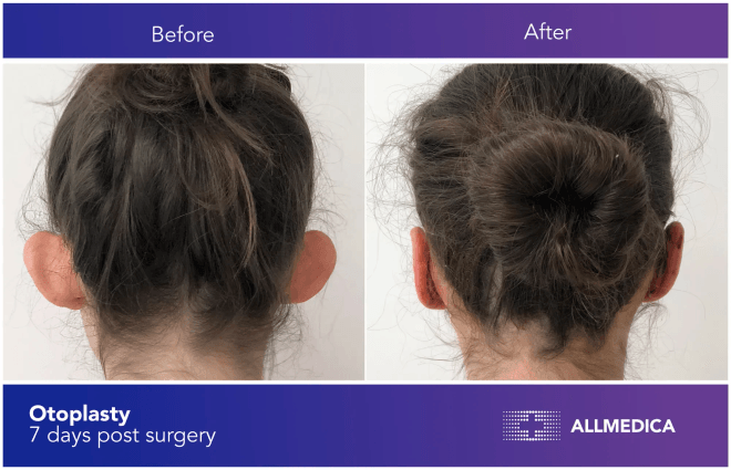 Otoplasty surgery