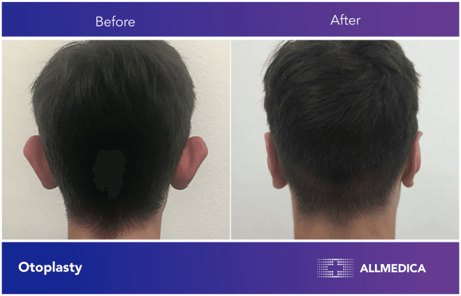 Otoplasty surgery