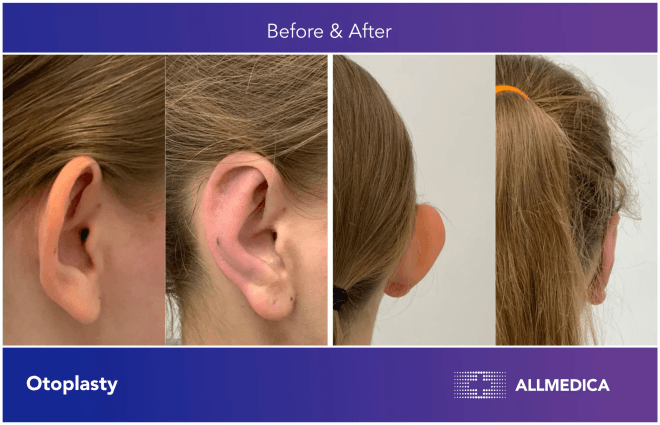 Otoplasty surgery