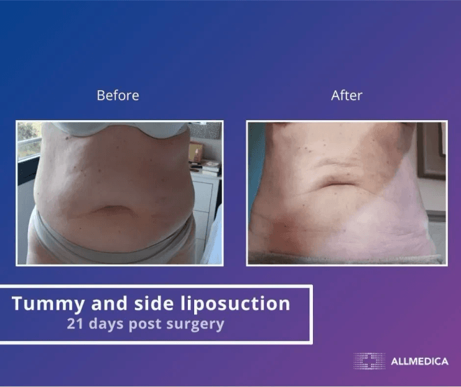Abdominal And Sides Liposuction - before (left) and after (right) result