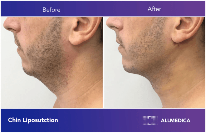 Chin Liposutction - before (left) and after (right) result