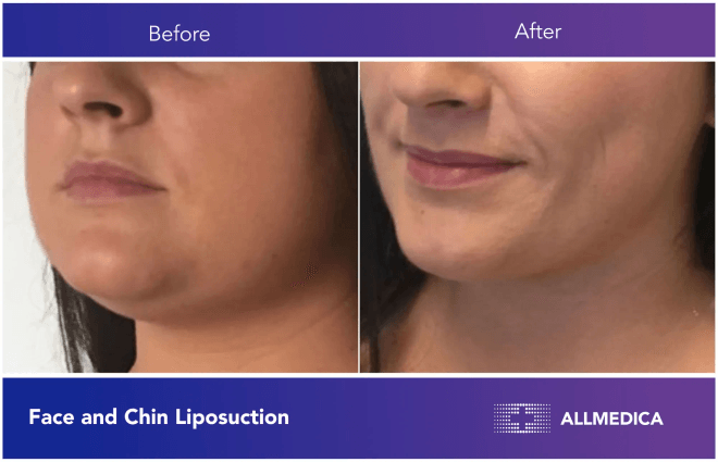 Face And Chin Liposuction - before (left) and after (right) result