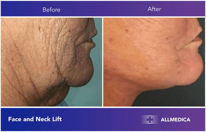 Face And Neck Lift - before (left) and after (right) result