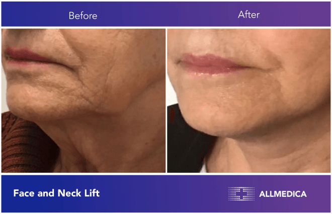 Face And Neck Lift - before (left) and after (right) result