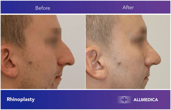 Rhinoplasty surgery