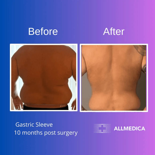 Weight loss after gastric sleeve