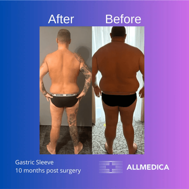 Weight loss after gastric sleeve