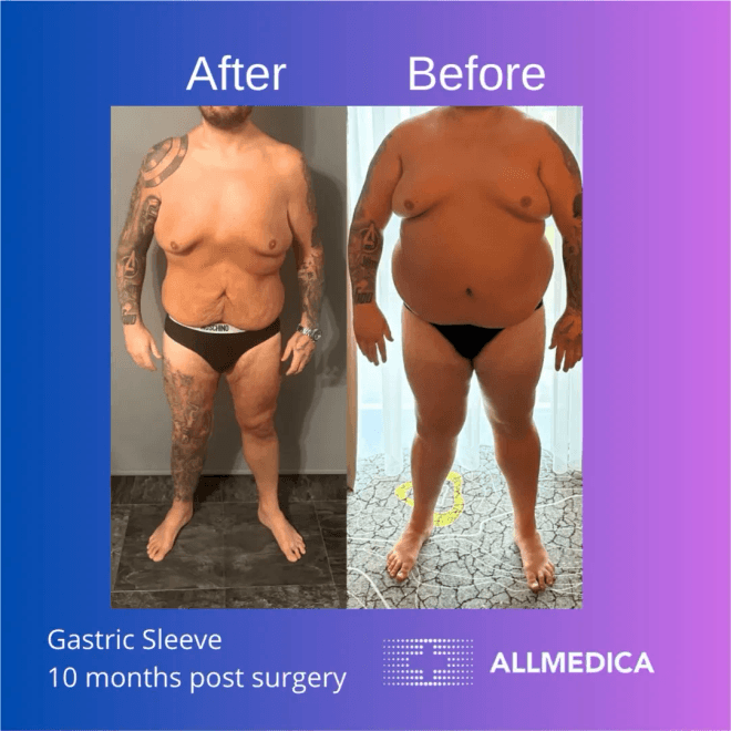 Weight loss after gastric sleeve